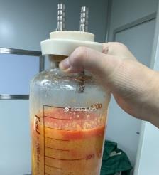 镇江水动力吸脂手术要做多久？